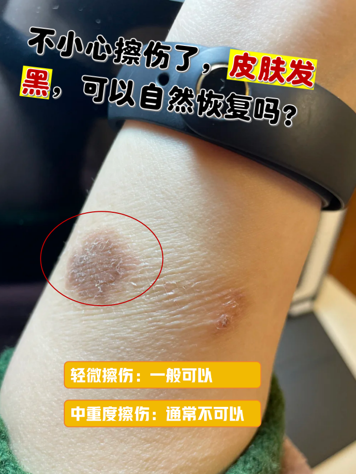 皮肤发黑是怎么回事