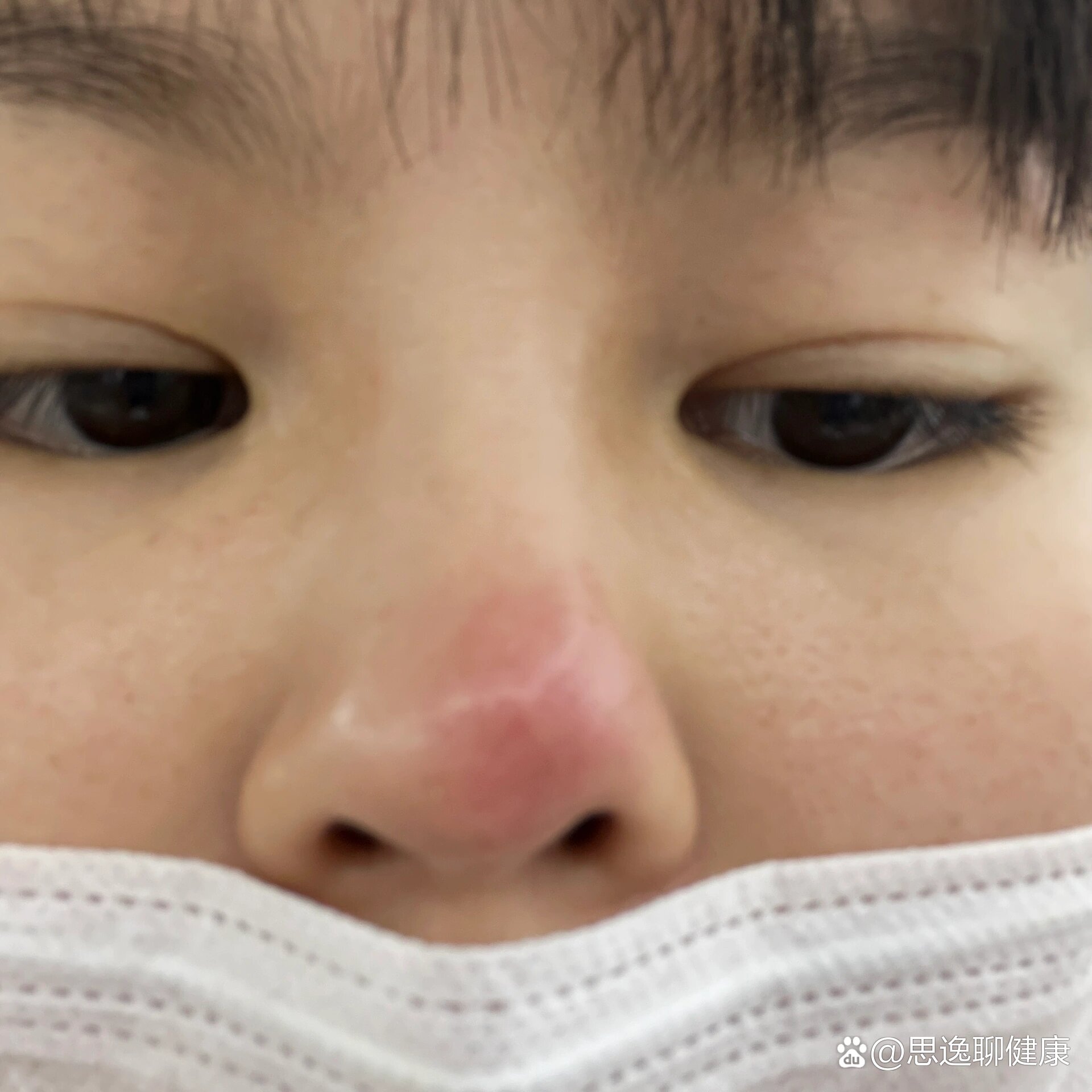 鼻疖是什么引起的?