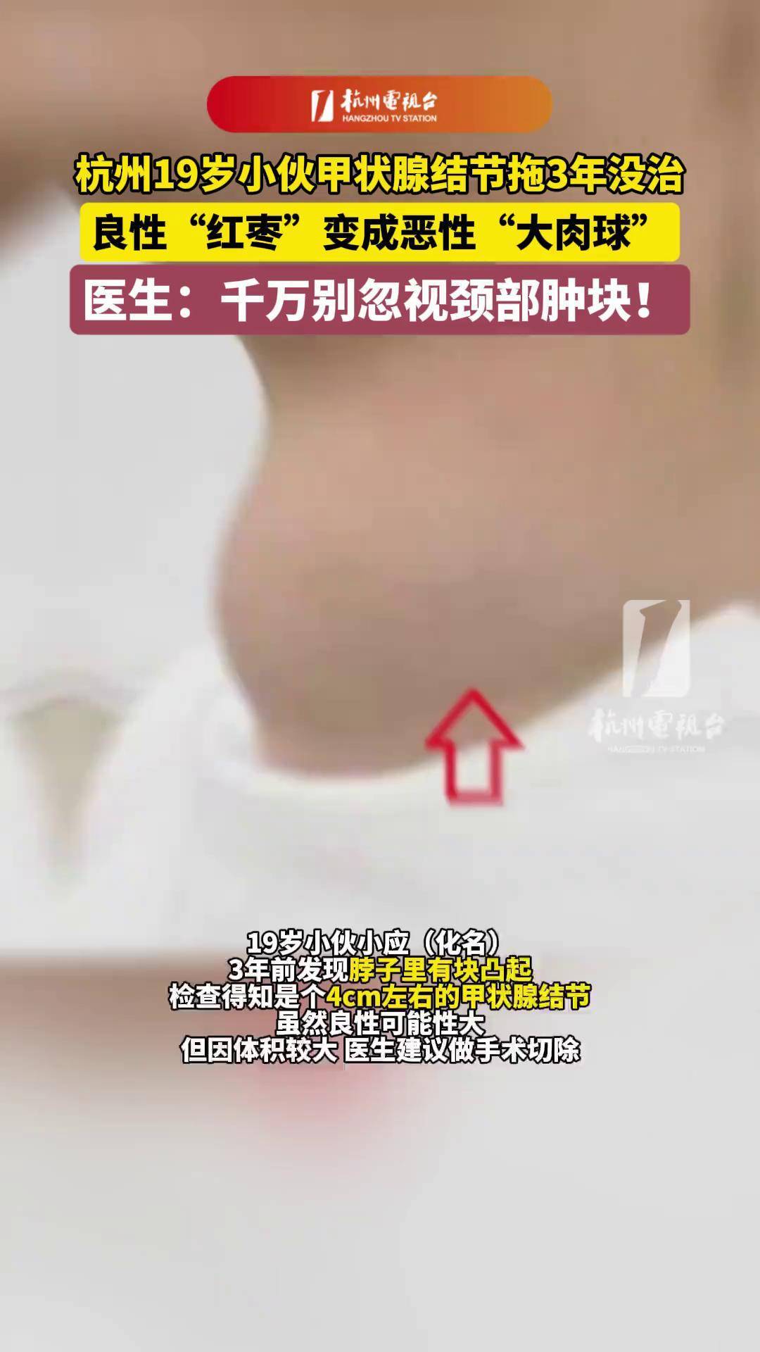 什么叫结节性甲状腺肿?