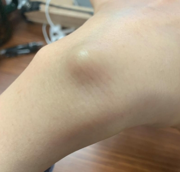 腱鞘囊肿有哪些危害?