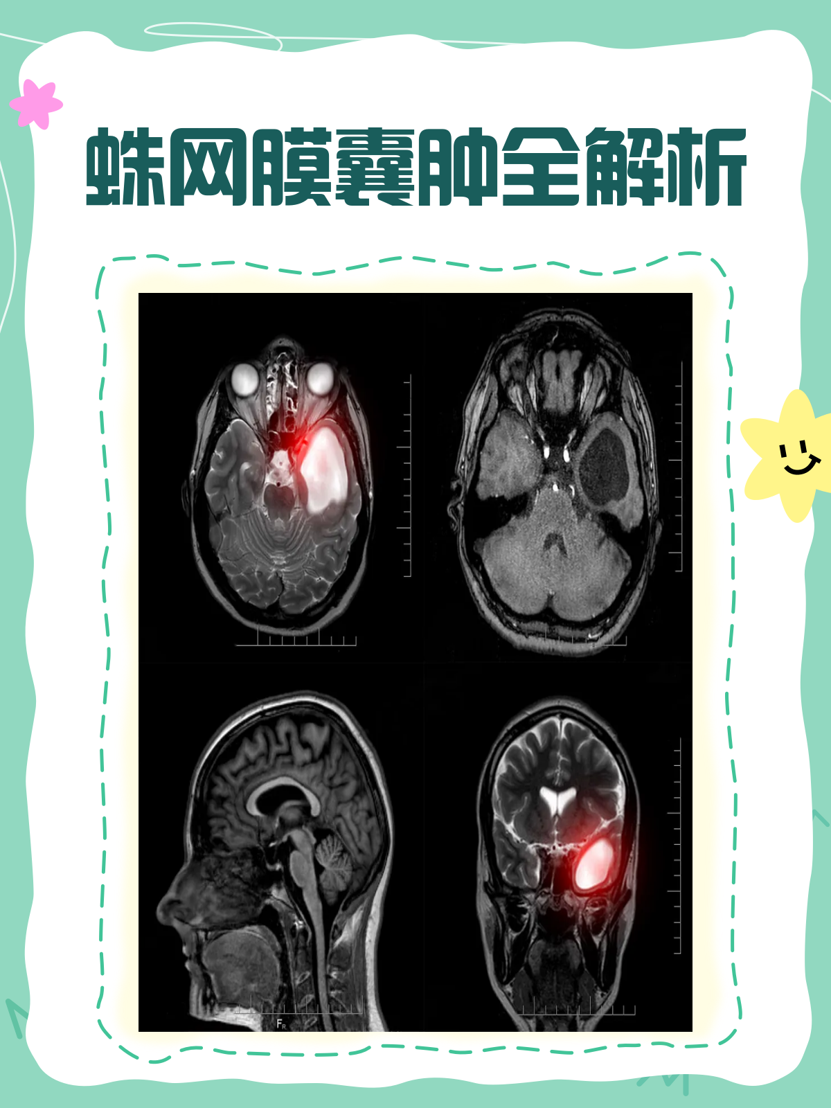 什么是蛛网膜囊肿?