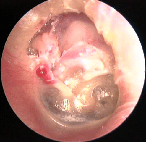 渗出性中耳炎能自愈吗