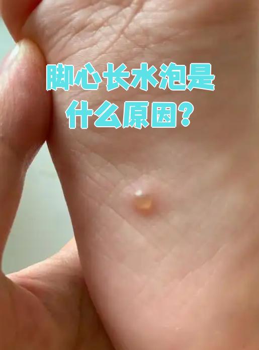 脚底长水泡怎么办