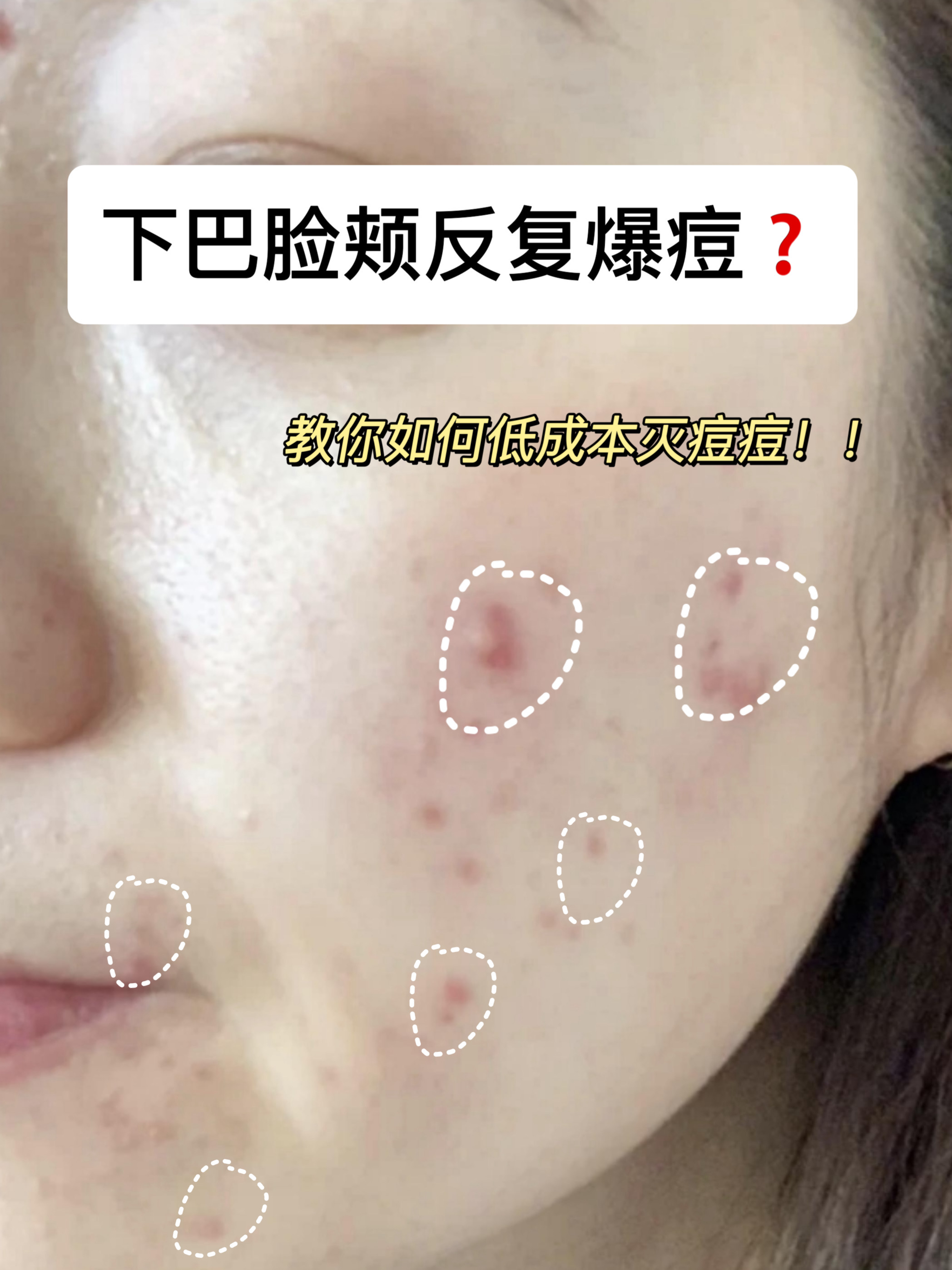 脸上长痘痘怎么办?