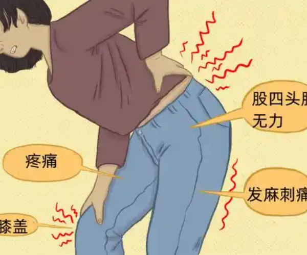 肾虚腰痛的症状有哪些