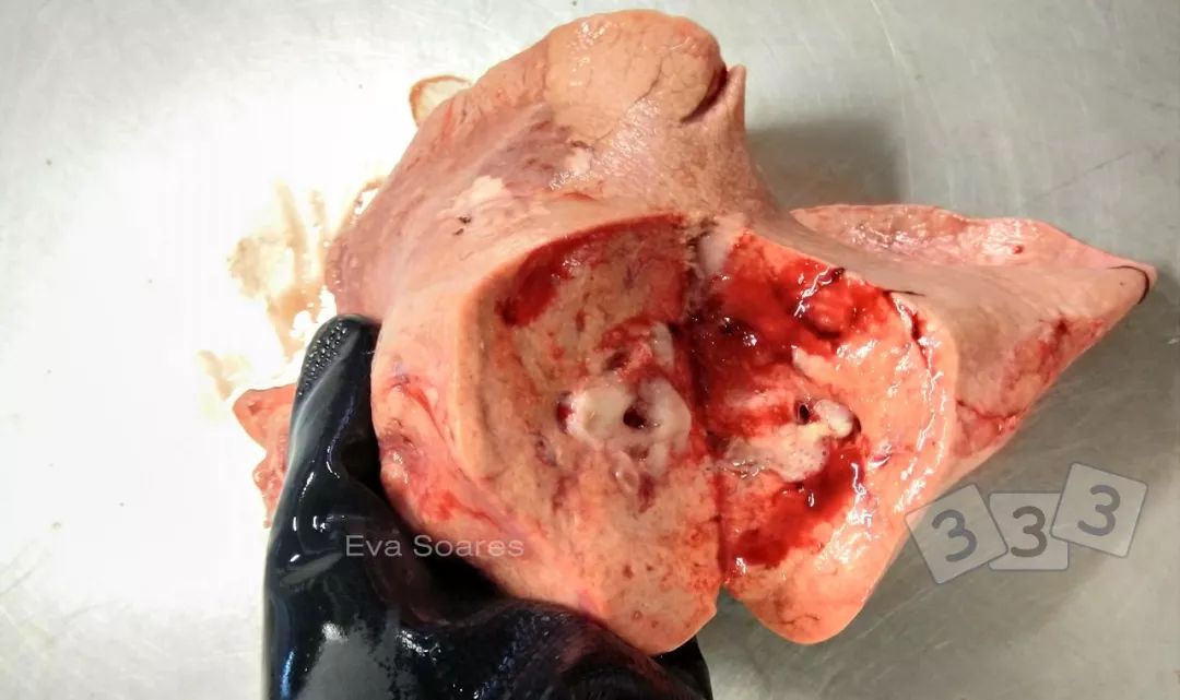 粉红色泡沫痰的病因