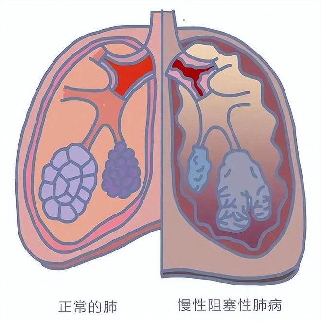 粉红色泡沫痰的病因