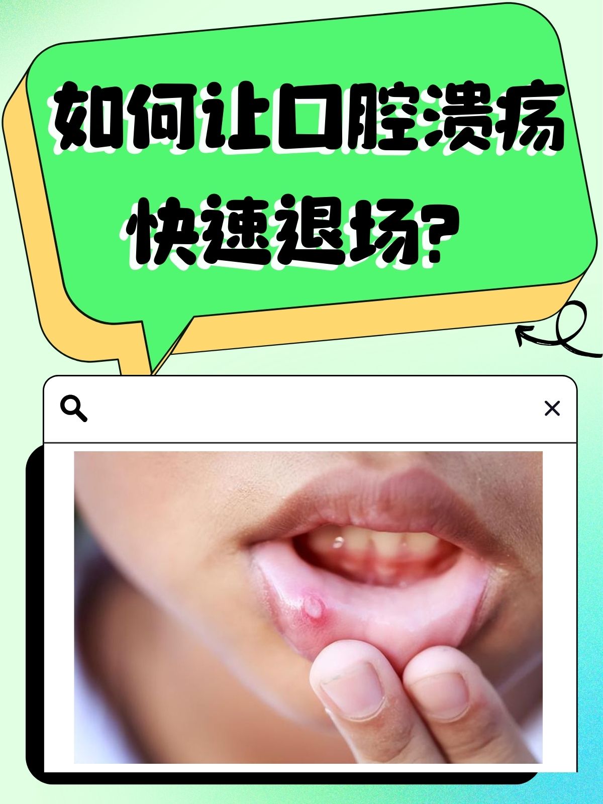 口腔溃疡严重怎么办?????