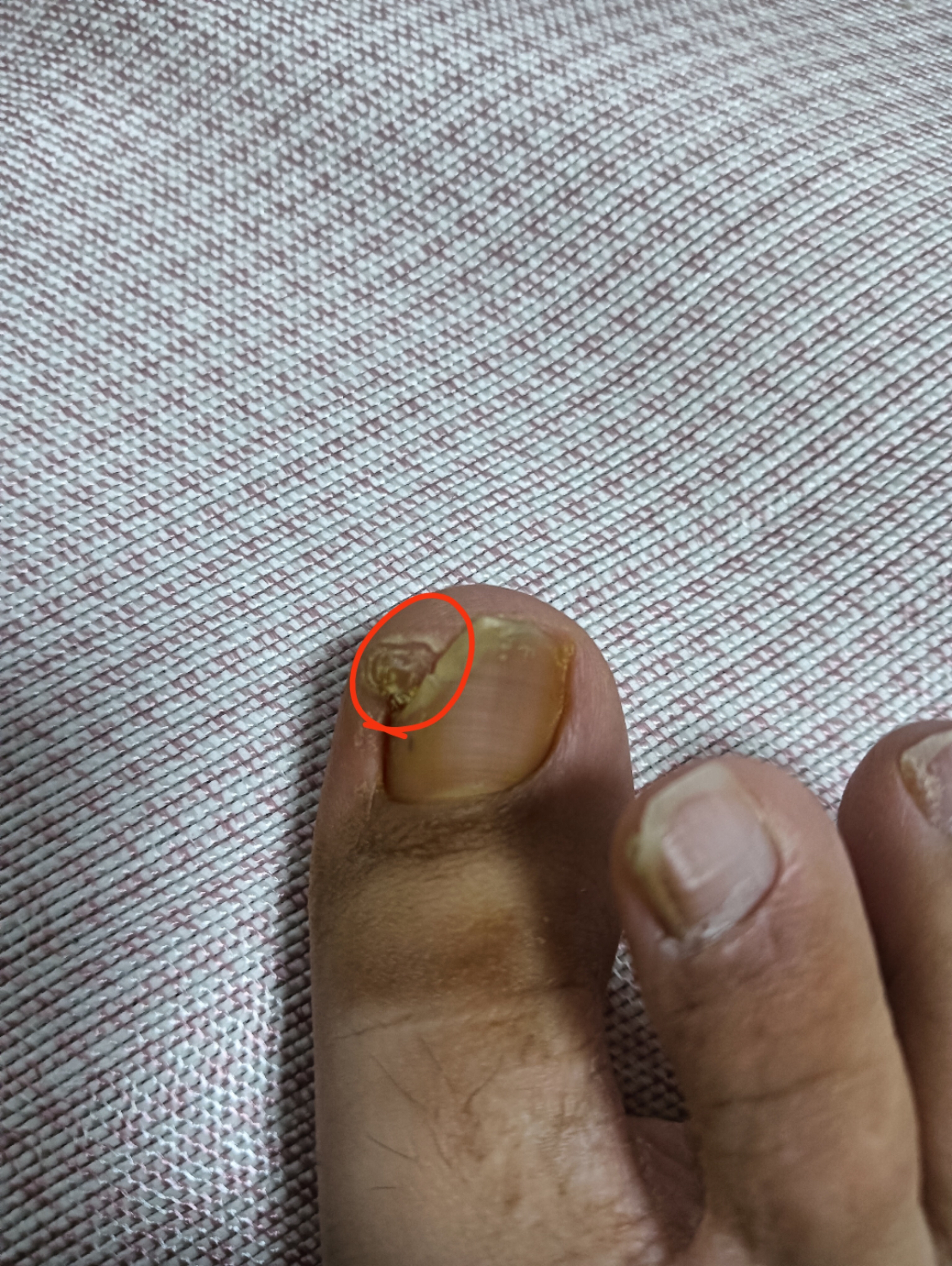 脚指甲凸凹不平是怎么回事