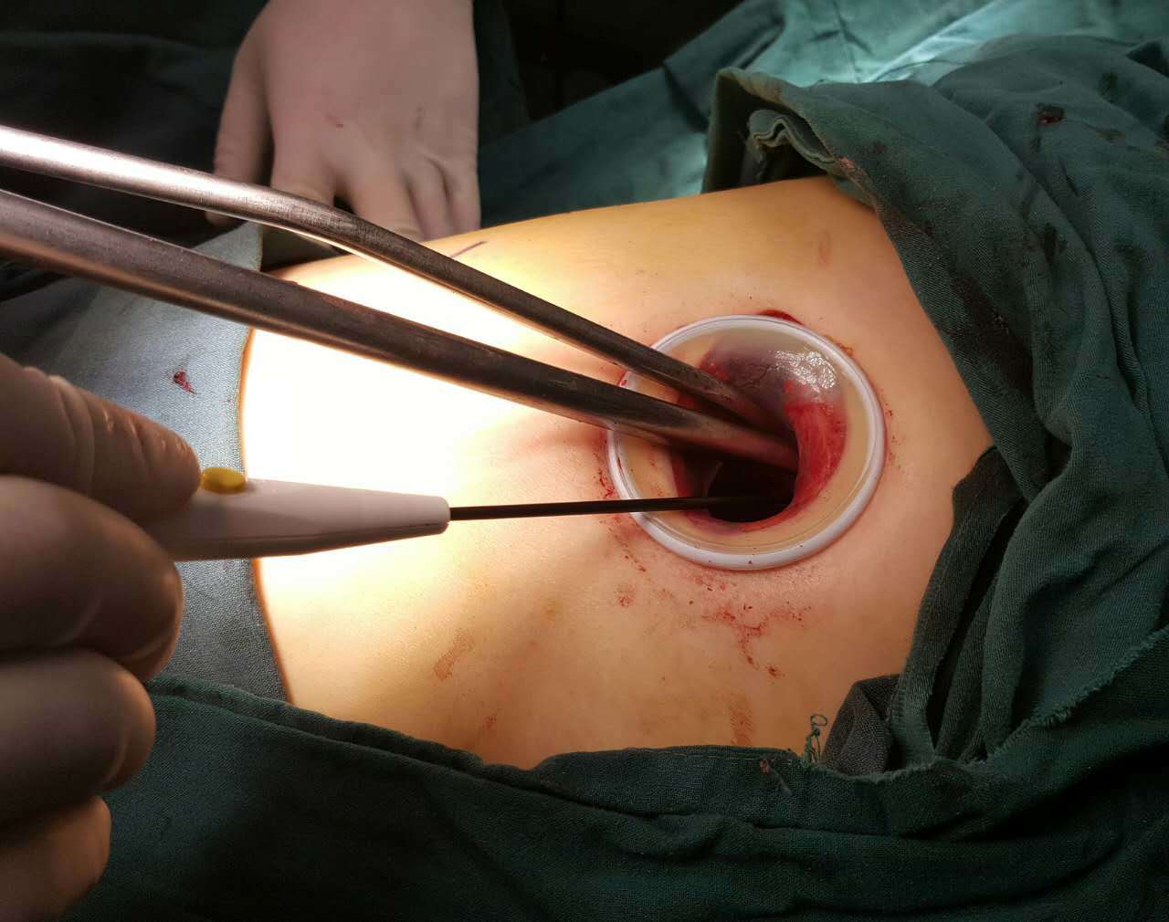 胸腔镜手术是怎么做的