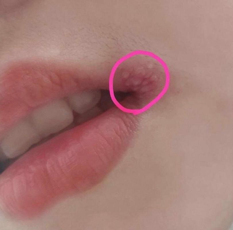 嘴唇起痘痘什么原因