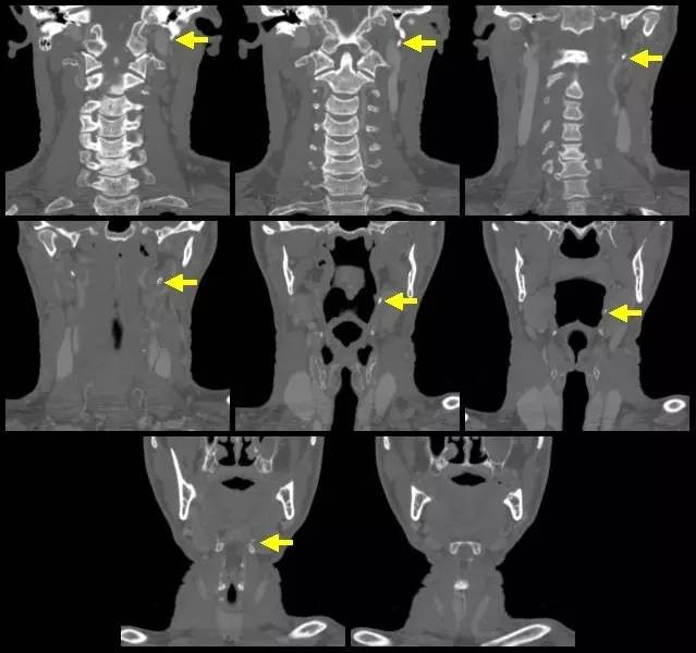 茎突过长有什么症状
