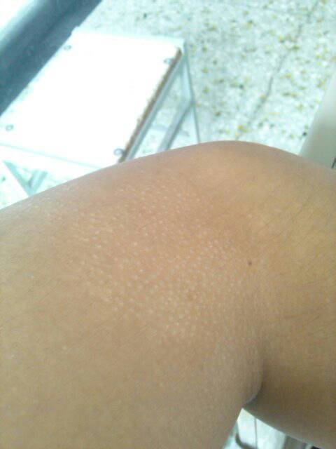 胳膊上有了小白点,好长时间了